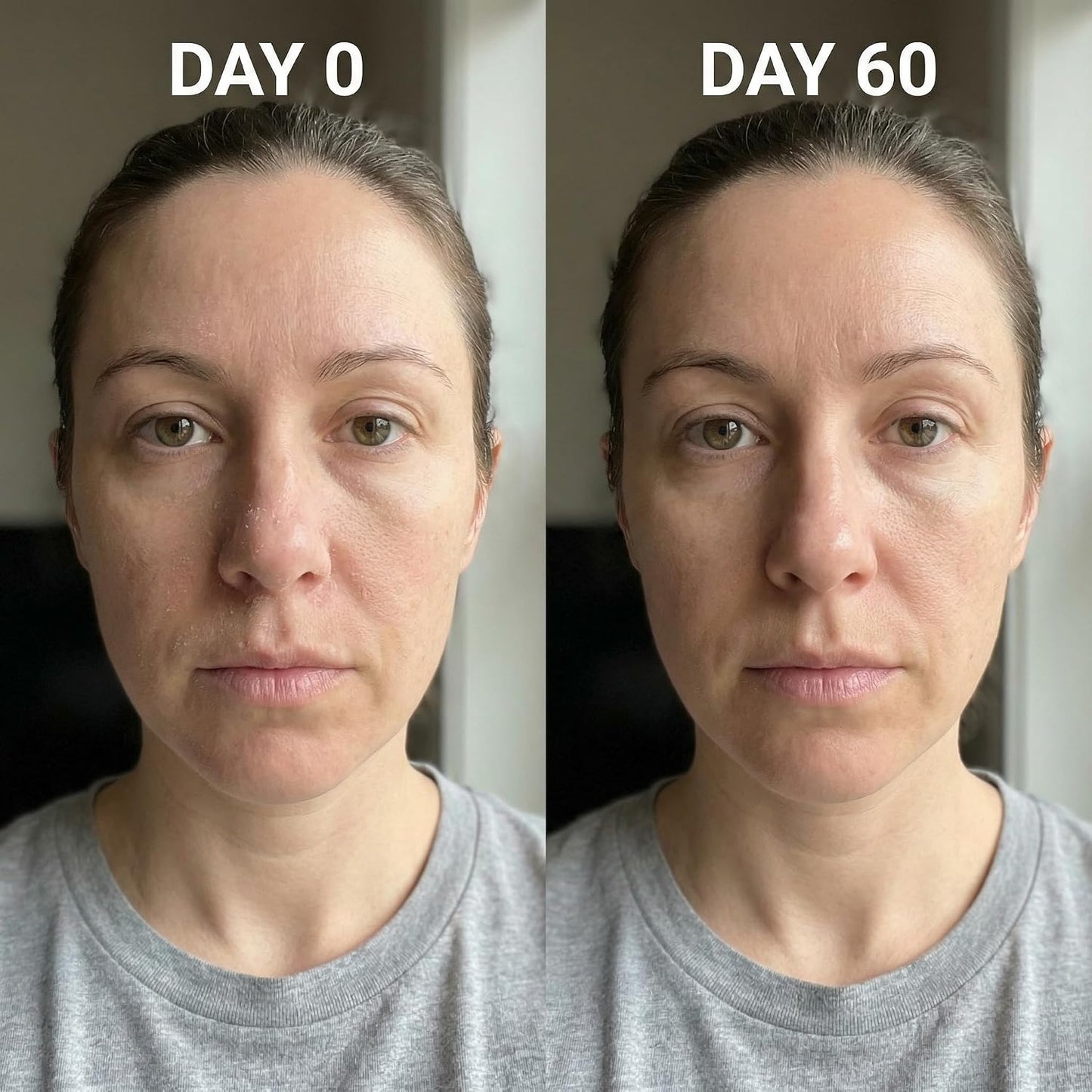 Micro Infusion System for Face & Neck-Micro Infusion Kit to Leave Skin Firmer & Smoother-0.25mm Facial Stamp with Collagen & Hyaluronic Acid Serum for At Home Glow and Anti-aging-2 Month Supply