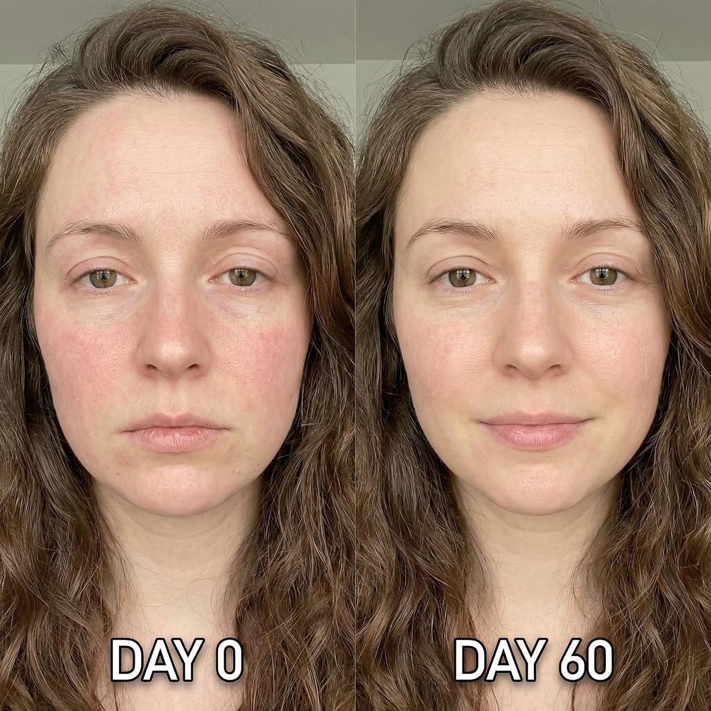 Micro Infusion System for Face & Neck-Micro Infusion Kit to Leave Skin Firmer & Smoother-0.25mm Facial Stamp with Collagen & Hyaluronic Acid Serum for At Home Glow and Anti-aging-2 Month Supply